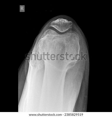 Knee joint patella skyline view x ray image 