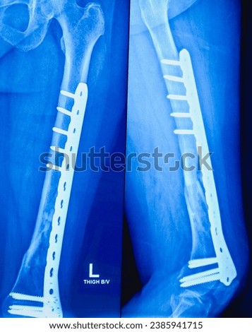 X-ray of Ankle view. Diffuse sclerosis with lytic area is noted in mid, distal shaft of the tibia results thickening of bony cortices with loss of medullary canal. Soft tissue appears mildly swollen. Royalty-Free Stock Photo #2385941715