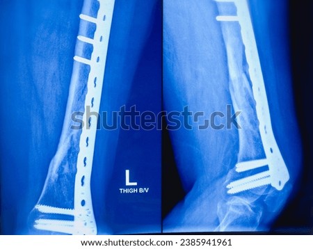 X-ray of Ankle view. Diffuse sclerosis with lytic area is noted in mid, distal shaft of the tibia results thickening of bony cortices with loss of medullary canal. Royalty-Free Stock Photo #2385941961