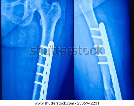 X-ray of Ankle view. Diffuse sclerosis with lytic area is noted in mid and distal shaft of the tibia results thickening of bony cortices with loss of medullary canal.  Royalty-Free Stock Photo #2385942231