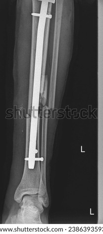 Orthopedic X-ray revealing the successful fixation of a complex tibial shaft fracture with an intramedullary nail.