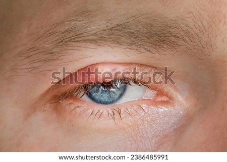 Chalazion, slow-growing lump or cyst that develops within the eyelid. Burst abscess, inflamed area of the eyelid. Eye diseas with swollen, inflamed eyelid. Chalazion on upper eyelid closeup. Royalty-Free Stock Photo #2386485991
