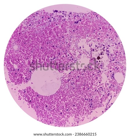 Larynx Cancer. Invasive squamous cell carcinoma. Section show malignant neoplasm. Royalty-Free Stock Photo #2386660215