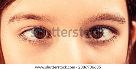 Strabismus. Little patient strabismus, treatment ophthalmic diseases. Strabismus in children causes, treatment concept. Female eyes with strabismus. Hypertropia. Royalty-Free Stock Photo #2386936635
