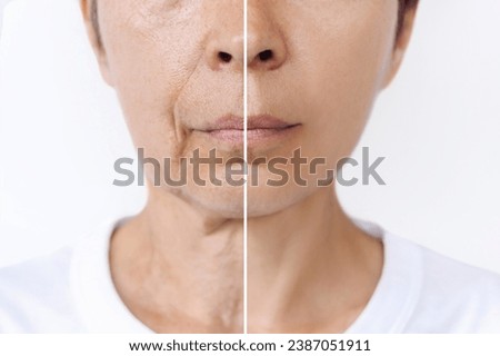 Lower part of face and neck of elderly woman with signs of skin aging before after plastic surgery. Age-related changes, flabby sagging skin, wrinkles, creases, puffiness. Rejuvenation, facelift Royalty-Free Stock Photo #2387051911
