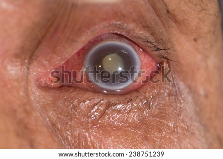 close up of the acute angle closure glaucoma during eye examination. Royalty-Free Stock Photo #238751239