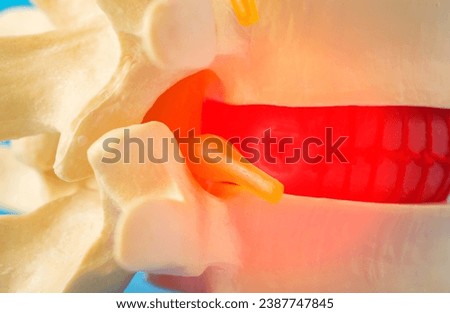 Red inflamed spine with a compressed nerve root, close-up. Neuralgia and radiculitis in diseases of the spine. Back pain, close-up Royalty-Free Stock Photo #2387747845
