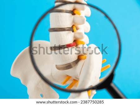 Intervertebral hernia of the lumbar spine under a magnifying glass, close-up. Sciatica and radiculitis, pinched nerve root, neuralgia. Vertebrology and orthopedics, lumbago Royalty-Free Stock Photo #2387750285