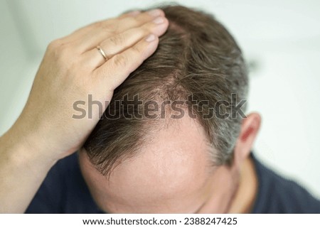 Baldness on the head of a middle-aged man. Hair loss.  Royalty-Free Stock Photo #2388247425
