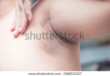 Picture of dark spots on the skin of a person's body, armpits