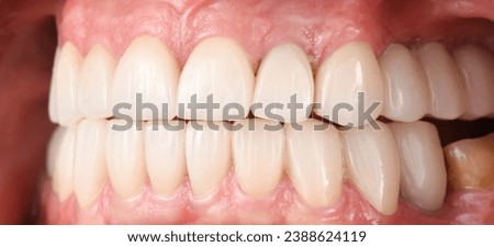 Emax crowns and veneers on teeth and implants Royalty-Free Stock Photo #2388624119