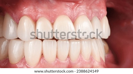 Emax crowns and veneers on teeth and implants Royalty-Free Stock Photo #2388624149