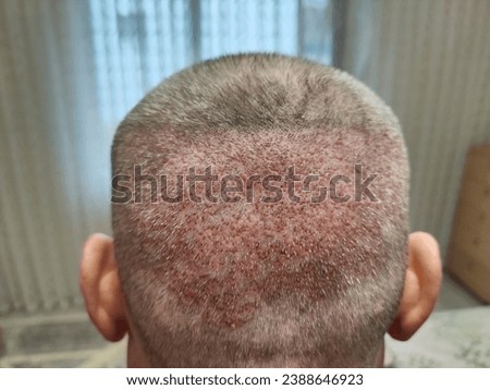 allergic photos of the front and back of the head of a man who has had a hair transplant Royalty-Free Stock Photo #2388646923