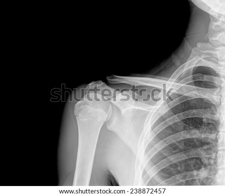 X-ray of human shoulder. front view