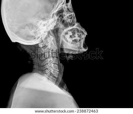 photo of side x-ray picture of human skull and neck in natural colors