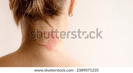 Manifestation of atopic dermatitis as a red itchy spot on a woman’s neck, close-up, rear view, copy space. Dermatology, allergy, itching, red spot or rash on skin Royalty-Free Stock Photo #2389071235