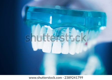 Dental tooth implant titanium prosthetic dentists model. Royalty-Free Stock Photo #2389241799