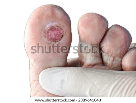 This close-up photo vividly reveals the severity of a foot ulcer—an infected wound demanding urgent attention. A stark depiction urging awareness on diabetic foot care and healthcare initiatives.

 Royalty-Free Stock Photo #2389641043