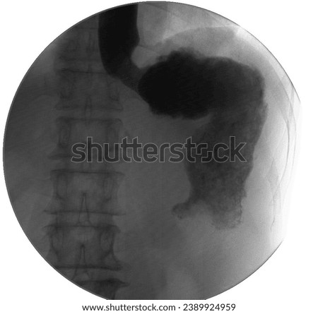 Diagnostic picture using barium powder mixed with water. Have the patient eat and look at the inside of the body using radiation. The test is called Barium swallow, Upper GI x-ray, Barium enema.