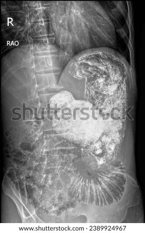 Diagnostic picture using barium powder mixed with water. Have the patient eat and look at the inside of the body using radiation. The test is called Barium swallow, Upper GI x-ray, Barium enema.
