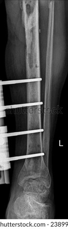 X-ray image showing external fixation of the lower limb, specifically the tibia. Royalty-Free Stock Photo #2389946953