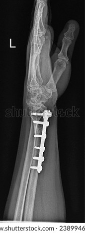 High-resolution X-ray capturing the successful fixation of a wrist joint fracture using a plate and screws. The image reveals the meticulous alignment of fractured wrist bones. Royalty-Free Stock Photo #2389946955