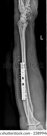 Radiographic view illustrating successful fixation of a forearm fracture using a plate and screws. The image highlights the precise alignment of the fractured forearm bones. Royalty-Free Stock Photo #2389946979