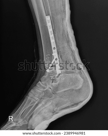 Orthopedic X-ray capturing meticulous fixation of an ankle joint fracture using a plate and screws. The image showcases the precise alignment of the fractured ankle bones. Royalty-Free Stock Photo #2389946981
