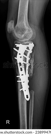 Lateral radiograph illustrating effective fixation of a proximal tibia and fibula fracture. The image reveals the precise alignment of the fractured bones, secured with orthopedic plate. Royalty-Free Stock Photo #2389947021