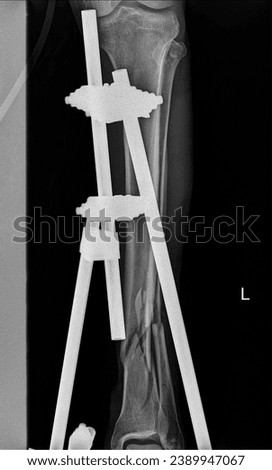 Radiographic Evaluation of External Fixation in Lower Limb: Orthopedic Intervention and Limb Stabilization Royalty-Free Stock Photo #2389947067