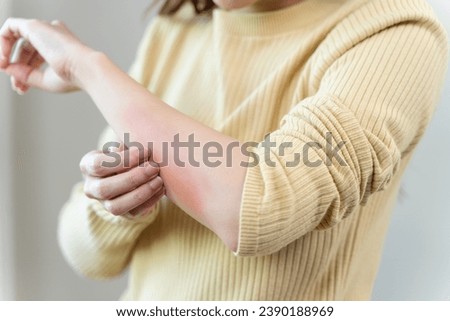 young woman scratching on her arm and has a red rash irritation on her skin from dust intolerance. Royalty-Free Stock Photo #2390188969