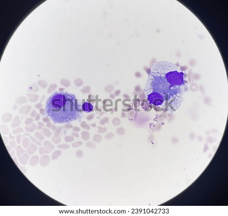 Abnormal cells in body fluids. Royalty-Free Stock Photo #2391042733