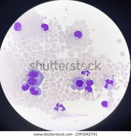 Abnormal cells in body fluids. Royalty-Free Stock Photo #2391042741