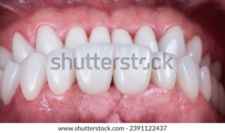 Emax ceramic crowns and veneers bl2 color Royalty-Free Stock Photo #2391122437