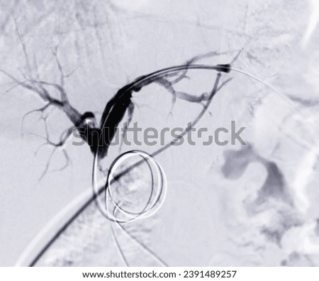 Percutaneous Transhepatic Biliary Drainage (PTBD) is a medical procedure used to treat bile duct blockages. Royalty-Free Stock Photo #2391489257