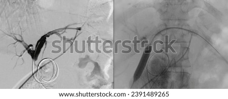 Percutaneous Transhepatic Biliary Drainage (PTBD) is a medical procedure used to treat bile duct blockages. Royalty-Free Stock Photo #2391489265