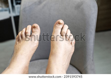 Nails of a 70-year-old woman with a defect of thickening on the foot. Onychodystrophy. Onychauxis. Royalty-Free Stock Photo #2391593745