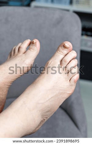 Nails of a 70-year-old woman with a defect of thickening on the foot. Onychodystrophy. Onychauxis. Royalty-Free Stock Photo #2391898695
