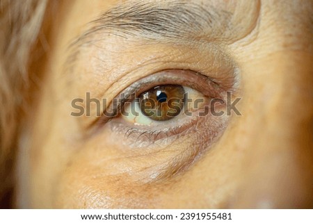 cancer patient. shot of the yellowish eyes. severe form of hepatitis. medical concept. life and health. Royalty-Free Stock Photo #2391955481
