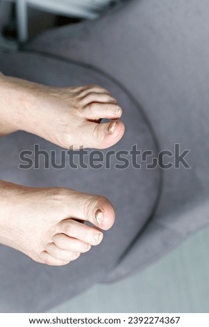 Nails of a 70-year-old woman with a defect of thickening on the foot. Onychodystrophy. Onychauxis. Royalty-Free Stock Photo #2392274367
