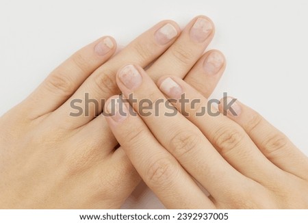Fingernails with onycholysis after removing gel polish on grey background. Womans hands with damaged nails Royalty-Free Stock Photo #2392937005