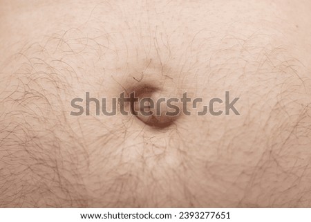 An umbilical hernia appears as a painless lump in or near the belly button (navel) Royalty-Free Stock Photo #2393277651
