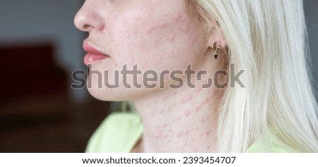 Real biorevitalization of the skin on a white background. Traces of injections of biorevitalization on the face of a woman. Traces of biorevitalization needles. Royalty-Free Stock Photo #2393454707