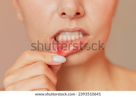 a close-up of the face of a young woman who turns her lip with her finger shows an ulcer of stomatitis in the acute stage on the mucous membrane of the mouth. Royalty-Free Stock Photo #2393510641