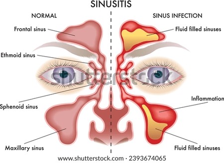 Medical  illustration of symptoms of Sinusitis. Royalty-Free Stock Photo #2393674065