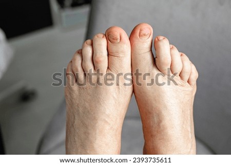 Nails of a 70-year-old woman with a defect of thickening on the foot after procedure podologist. Onychodystrophy. Onychauxis. Royalty-Free Stock Photo #2393735611
