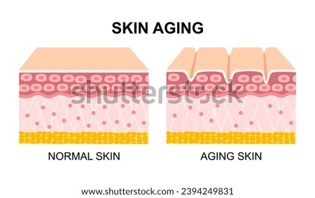 Aging process. comparison of young and aged skin. collagen, elastin and fibroblasts in younger and older skin. Age-related changes in the skin when collagen fibers atrophy, and elastin broken.