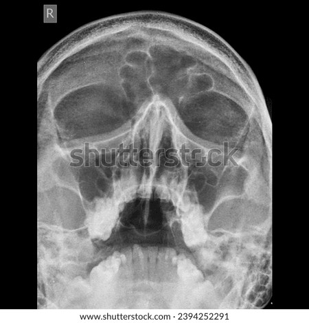 Nasal bone x-ray image pa view 