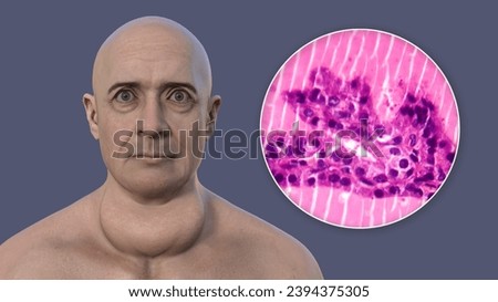 A 3D illustration of a man with enlarged thyroid gland and exophthalmos, alongside with a micrograph image of thyroid tissue affected by toxic goiter.