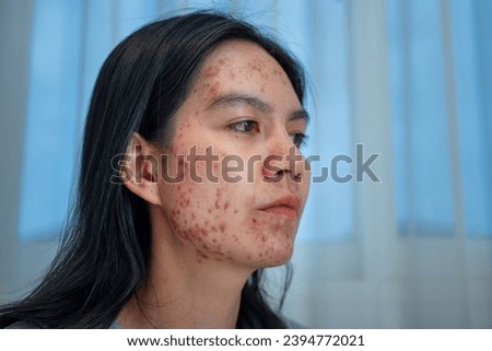 Acne on face because the disorders of sebaceous glands productions.  Acne or a Cosmetic Allergy. Hormonal changes and Foods Cause Symptoms of Skin Allergies  Royalty-Free Stock Photo #2394772021